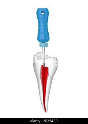 3D-Rendering von Prämolarenzähnen mit endodontischer C-Feile auf weißem Hintergrund. Endodontisches Behandlungskonzept. Stockfoto