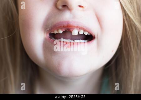 Ein süßes Mädchen hat ihren Milchzahn verloren. Kind mit frischer Wunde nach Milchzahnauszug. Das Konzept der Mundhygiene bei Kindern. Schließen- Stockfoto