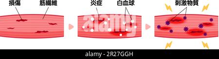 Zur Darstellung des Mechanismus der Muskelschmerzen als Vektordarstellung Stock Vektor