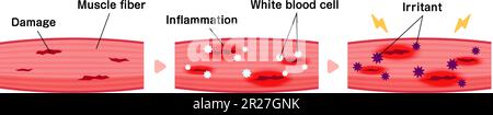 Zur Darstellung des Mechanismus der Muskelschmerzen als Vektordarstellung Stock Vektor