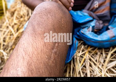 Vorderer Kreuzbanderriss Arthroskopie Knochenschmerzen geschwollener Bewegungsbereich Oberschenkelknochen Ruhe-Eis Behandlung erste-Hilfe-Heilung Stockfoto