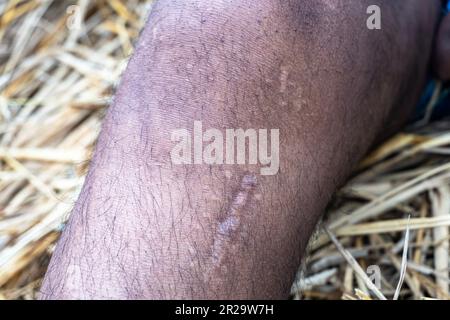 ACL-Verletzung, gerissenes vorderes Kreuzband. Stockfoto