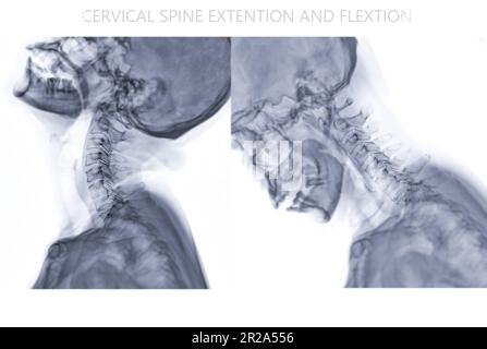 Röntgen-HWS- oder Röntgenbild der Halswirbelsäulenbeugung und Streckungsansicht zur diagnostischen Bandscheibenherniation, Spondylose und Fraktur. Stockfoto