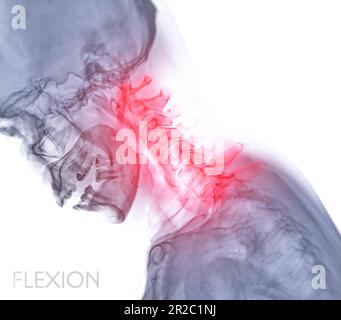 Röntgenaufnahme der Halswirbelsäule oder Röntgenbild der Halswirbelsäulenbeugung zur diagnostischen Bandscheibenherniation, Spondylose und Fraktur. Stockfoto