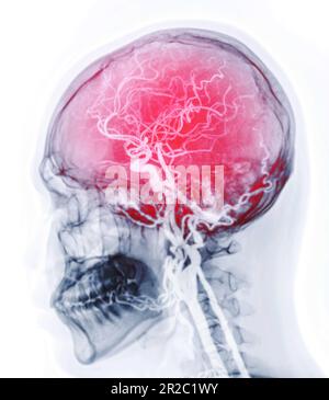 CTA-Gehirn- oder CT-Angiographie des Gehirns 3D-Rendering-Bildfusion mit lateraler Schädelansicht, die die Arteria cerebri und Arteria carotis communis im b zeigt Stockfoto
