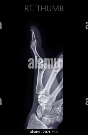 X-Raiy-Bild des Daumenfingers. Stockfoto