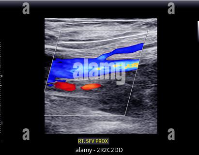 Farbdopplersonographische Bestimmung bei Patienten mit tiefer Venenthrombose zum Nachweis tiefer Venenthrombosen der unteren Extremität. Stockfoto