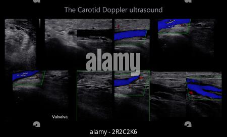 Ein Doppler-Ultraschall der A. carotis ist ein diagnostischer Test, der verwendet wird, um die Arterien im Hals zu untersuchen, um eine Blockierung der Venen durch eine Blutgruppe zu diagnostizieren Stockfoto