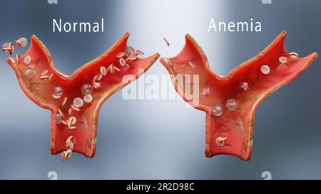 Blutkörperchen- oder Hämoglobinanämie und normal. Aplastische Anämie, normale und abnorme Anzahl von Blutzellen und Blutplättchen, Blutkreislauf in einer Arterie oder Stockfoto