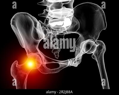 Hüftgelenksschmerzen, konzeptionelle Illustration Stockfoto