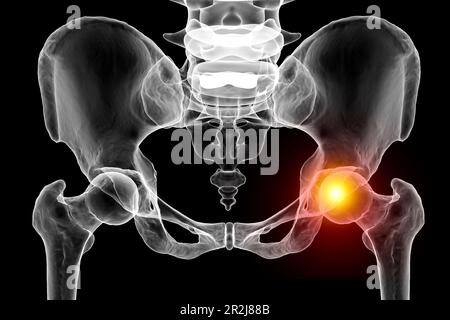 Hüftgelenksschmerzen, konzeptionelle Illustration Stockfoto