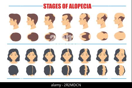 Stadien des männlichen und weiblichen Alopezie-Vektorensatzes Stock Vektor