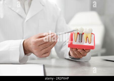 Der Arzt zeigt das Bildungsmodell des Zahnimplantats in der Klinik, Nahaufnahme Stockfoto