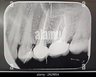 Der Arzt untersucht ein kleines Röntgenbild nach der Behandlung der Zähne des Patienten Stockfoto