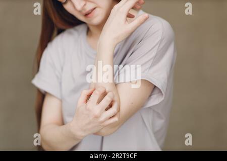 Allergische Dermatologie Skabies Juckreiz Hand Hautproblem Frau Stockfoto