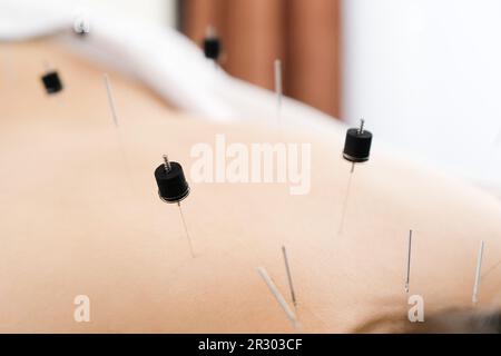 Eine Frau mit einer Nadel am Rücken in einer hellen Akupunkturklinik Stockfoto