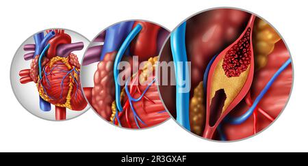 Bypass-Operation und Koronararterien-Grafting oder CABG als Plaquebeschränkung in der Koronararterie oder Arterien als Beinvene Stockfoto