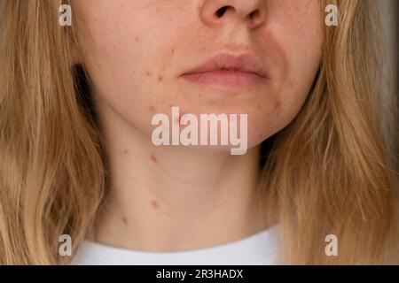 Eine nicht wiedererkennbare Frau, die ihre Akne im Gesicht zeigt. Nahaufnahme Akne im Gesicht der Frau mit Hautausschlag, Narbe und Flecken, die allergisch gegen Kosmos sind Stockfoto