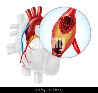 Herzarterien-Bypass-Grafting oder CABG als Verschluss von Plaque in der Koronararterie oder Arterien als Vene von einem Bein, das in ein Herz transplantiert wird Stockfoto