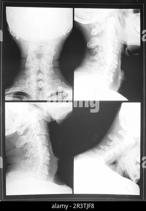 Die Röntgenaufnahme des Zervix Stockfoto