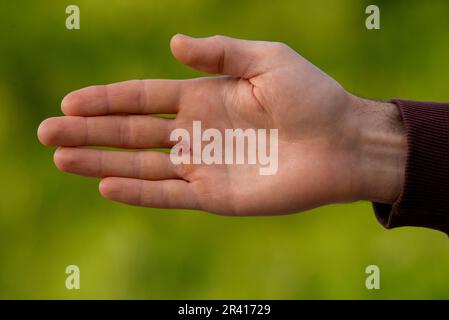 Menschlich verletzte Handflächen Hand litt Blasen und Kalluskerne Grüner natürlicher Hintergrund-Naht Stockfoto
