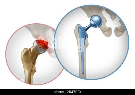 Hüftchirurgie und Beckengelenkersatz als künstliches Gelenk oder Prothese mit orthopädischer Chirurgie unter Einsatz einer Metallkugel Stockfoto