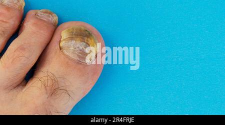 Nahaufnahme aller männlichen Fuß-Miniaturbilder, Pilznagel auf blauem Hintergrund. Stockfoto