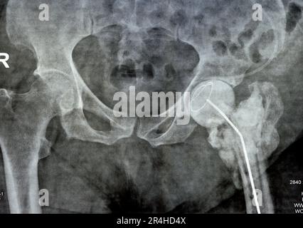 Das reine Röntgenstrahl des Hüftgelenks zeigt die linke transzervikale Femurkopffraktur mit temporärem antibiotikabelastetem Knochenzement hinten Stockfoto