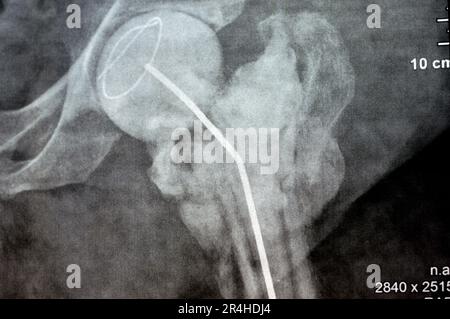 Das reine Röntgenstrahl des Hüftgelenks zeigt die linke transzervikale Femurkopffraktur mit temporärem antibiotikabelastetem Knochenzement hinten Stockfoto