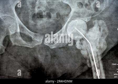 Das reine Röntgenstrahl des Hüftgelenks zeigt die linke transzervikale Femurkopffraktur mit temporärem antibiotikabelastetem Knochenzement hinten Stockfoto