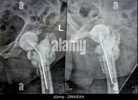 Das reine Röntgenstrahl des Hüftgelenks zeigt die linke transzervikale Femurkopffraktur mit temporärem antibiotikabelastetem Knochenzement hinten Stockfoto
