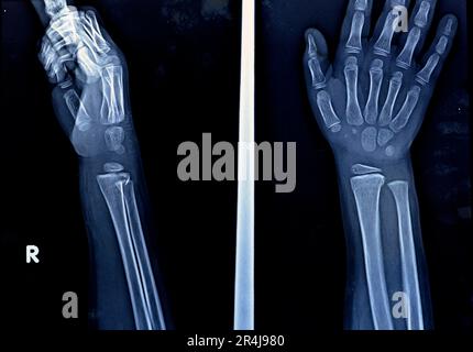 Eine PXR-Röntgenaufnahme des rechten Handgelenks einer skelettal unreifen weiblichen Patientin zeigt eine vernachlässigte physäre Verletzung des rechten distalen Radiusknochens, Verletzung Stockfoto
