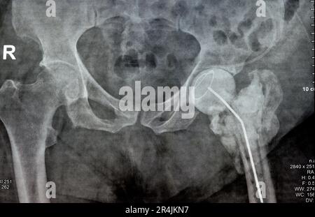 Das reine Röntgenstrahl des Hüftgelenks zeigt die linke transzervikale Femurkopffraktur mit temporärem antibiotikabelastetem Knochenzement hinten Stockfoto