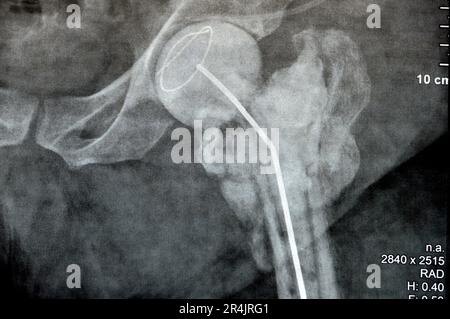 Das reine Röntgenstrahl des Hüftgelenks zeigt die linke transzervikale Femurkopffraktur mit temporärem antibiotikabelastetem Knochenzement hinten Stockfoto