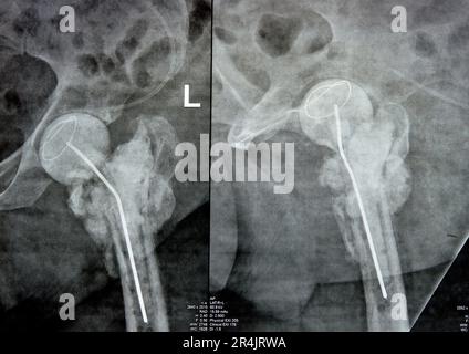 Das reine Röntgenstrahl des Hüftgelenks zeigt die linke transzervikale Femurkopffraktur mit temporärem antibiotikabelastetem Knochenzement hinten Stockfoto