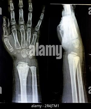 Eine PXR-Röntgenaufnahme des rechten Handgelenks einer skelettal unreifen weiblichen Patientin zeigt eine vernachlässigte physäre Verletzung des rechten distalen Radiusknochens, Verletzung Stockfoto