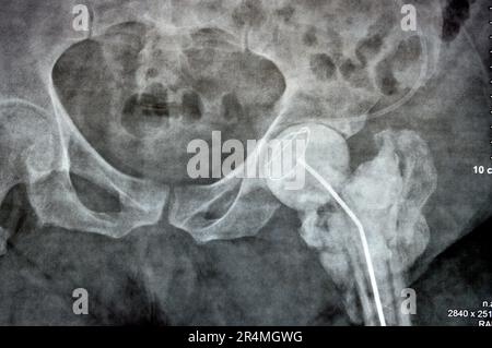 Das reine Röntgenstrahl des Hüftgelenks zeigt die linke transzervikale Femurkopffraktur mit temporärem antibiotikabelastetem Knochenzement hinten Stockfoto