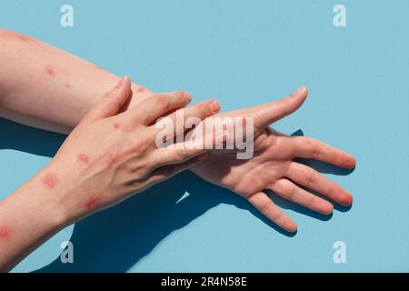 Affen-Pocken-neue Krankheit gefährlich auf der ganzen Welt. Patient mit Affenpocken. Schmerzhafter Ausschlag, rote Flecken Bläschen an der Hand. Hautausschlag, menschliche Hände Stockfoto