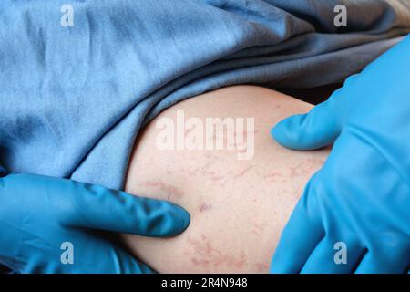 Ein Phlebologe untersucht einen Patienten mit Krampfadern am Bein. Beinschmerzen. Phlebologie. Venöse Pathologien der unteren Extremitäten. Menschliches Gefäß, arter Stockfoto