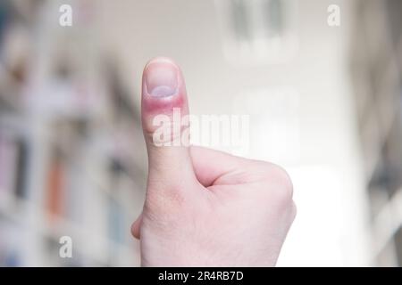 Mann mit Hand und Finger in Pain​ mit roter Markierung Stockfoto