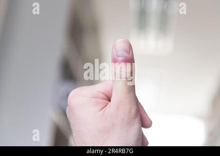 Mann mit Hand und Finger in Pain​ mit roter Markierung Stockfoto