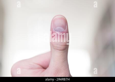 Mann mit Hand und Finger in Pain​ mit roter Markierung Stockfoto