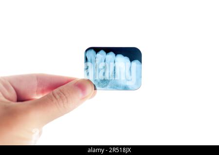 Nahaufnahme einer Hand, die einen zahnärztlichen Röntgenfilm gegen eine Lichtbox hält und eine Detailansicht eines Zahnes offenbart. Zahngesundheit, kieferorthopädische Behandlungen, Zahnmedizin Stockfoto
