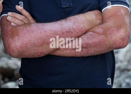 Erkrankungen durch Missbildungen der Lymphe. Psoriasis ist eine Hautkrankheit Stockfoto