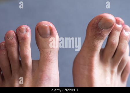 Die Zehen eines Mannes zeigen einen Ausschlag mit roter fleckiger Haut. Eine häufige Nebenwirkung von Covid-19, die oft als Covid-Zeh bezeichnet wird. Stockfoto