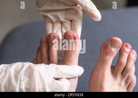 Die Zehen eines Mannes zeigen einen Ausschlag mit roter fleckiger Haut. Eine häufige Nebenwirkung von Covid-19, die oft als Covid-Zeh bezeichnet wird. Stockfoto