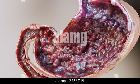 Magenkrebs. Stadien des Tumorwachstums im Verdauungssystem, peptisches Ulkus, Krebs attackierende Zelle. Magenkrankheitskonzept. Symptome, bösartige Krebserkrankungen, Stockfoto