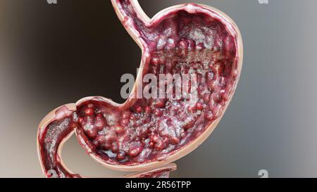 Magenkrebs. Stadien des Tumorwachstums im Verdauungssystem, peptisches Ulkus, Krebs attackierende Zelle. Magenkrankheitskonzept. Symptome, bösartige Krebserkrankungen, Stockfoto