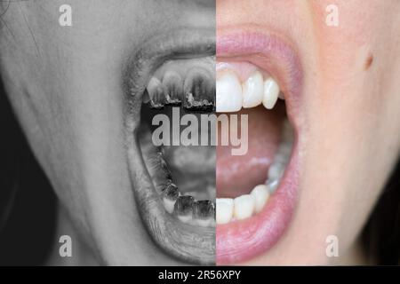 Der offene Mund eines Mädchens mit einer brennenden Zigarette anstelle von Zähnen ist ein Beispiel für vor und nach dem Rauchen, die Schäden durch Rauchen, sucht, schlechte Zähne Stockfoto
