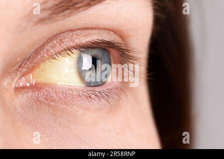Frau mit gelben Augen, Nahaufnahme. Symptom der Hepatitis Stockfoto